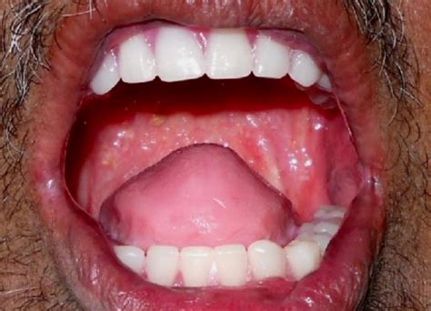 Total glossectomy for tongue cancer .